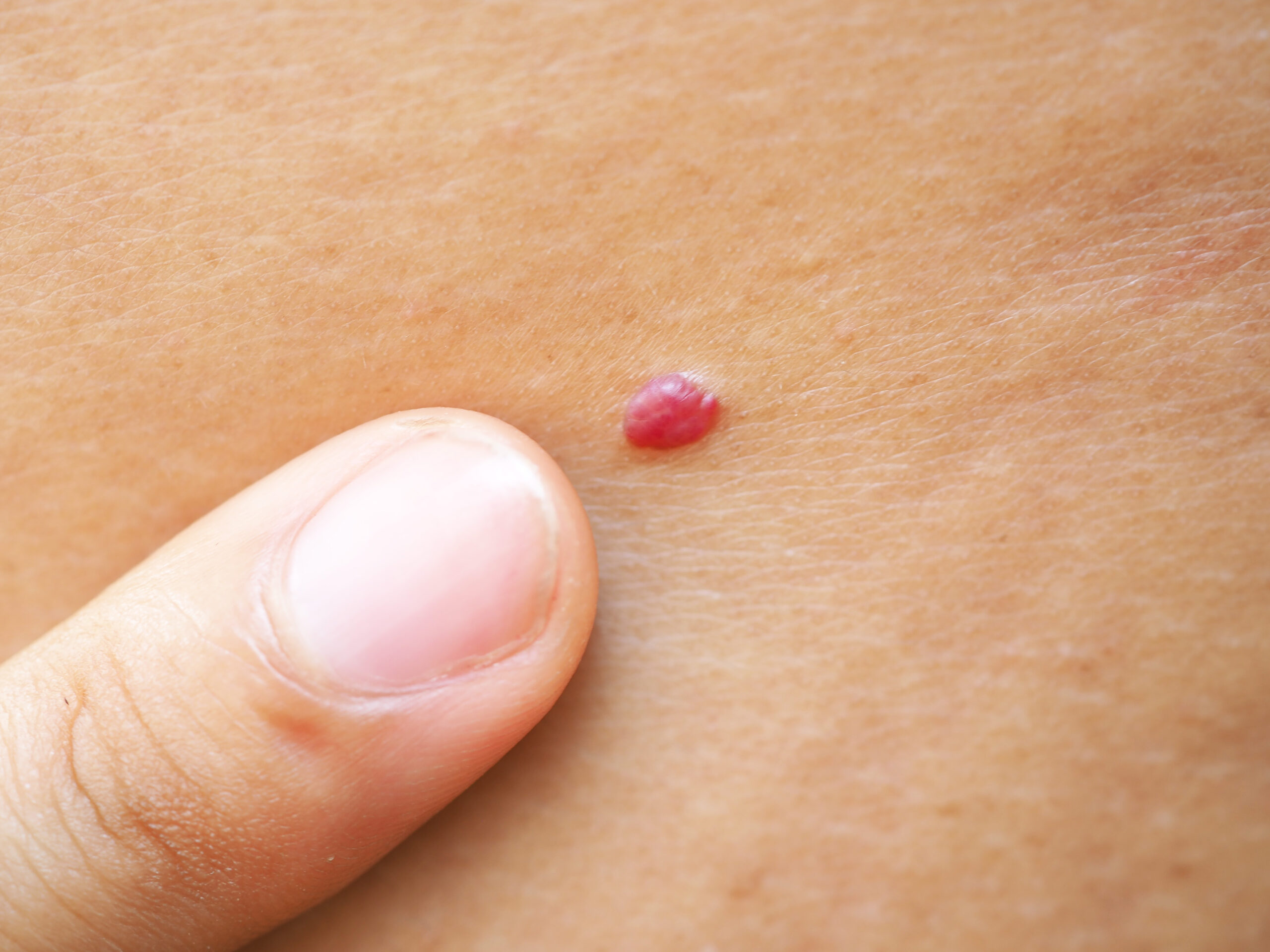 Skin Tag Removal