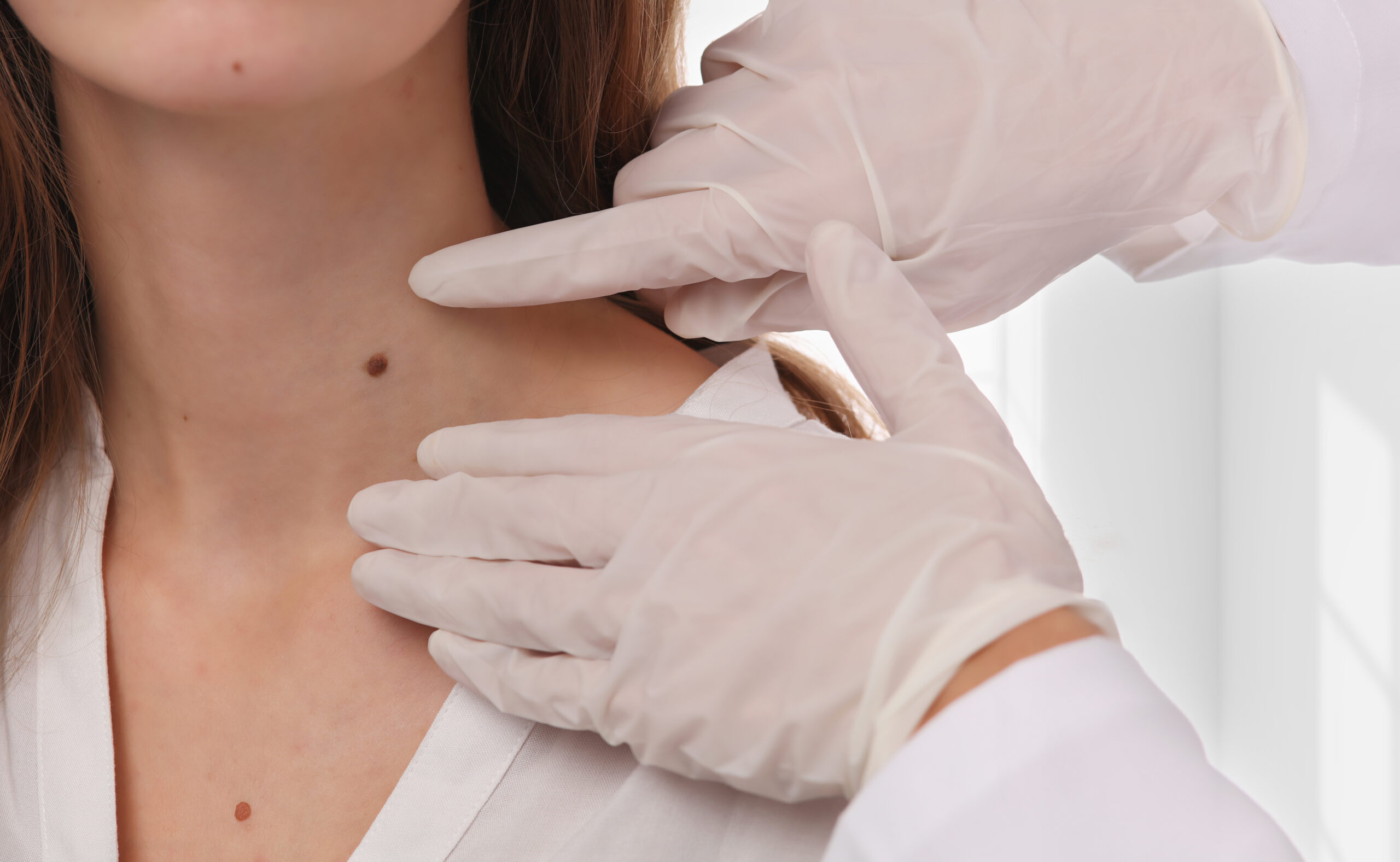 Ellman Scarless Mole Removal
